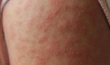 儿童接触性皮炎都有哪些类型？该如何预防这种事情的发生？