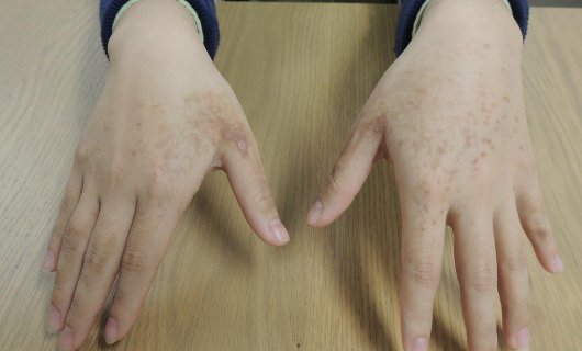 有谁知道查过敏原需要多少钱，脱敏治疗需要多长时间，脱敏治疗能治好吗