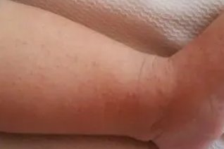 儿童接触性皮炎都有哪些类型？该如何预防这种事情的发生？