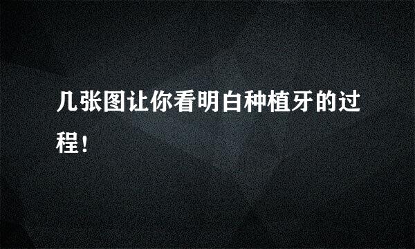 几张图让你看明白种植牙的过程！